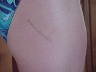 Hip Mini Incision